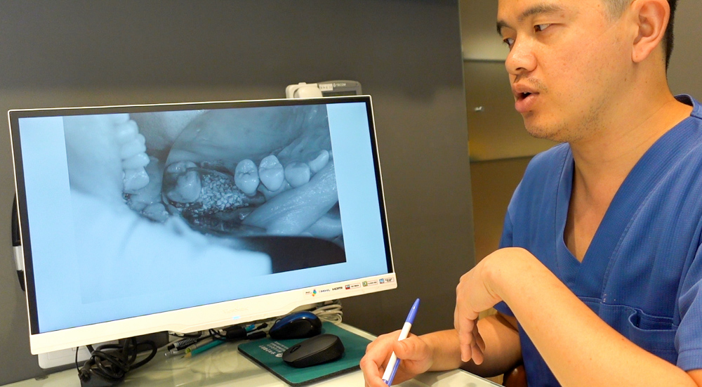 隱適美矯正日記II：打地基之路-補骨粉的過程分享，康澤牙醫